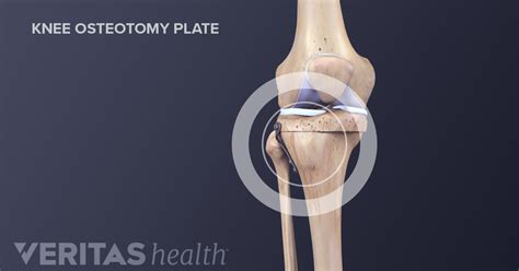 Knee Osteotomy Surgery