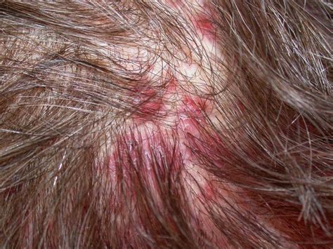 Pilar Cysts On Scalp Pictures Photos