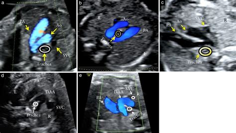 Identification And Management Of Fetal Isolated Right‐sided Aortic Arch
