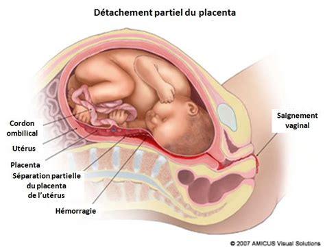 Ces saignements sont généralement bénins. Troisième Trimestre de la grossesse et Saignement ...