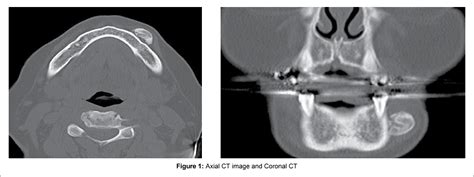Figure 1 From Recurrent Osseous Choristoma Involving The Mandibular
