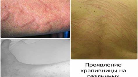 При крапивницы диета