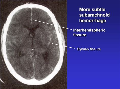 Ppt Critical Care Of The Patient With Acute Subarachnoid Hemorrhage