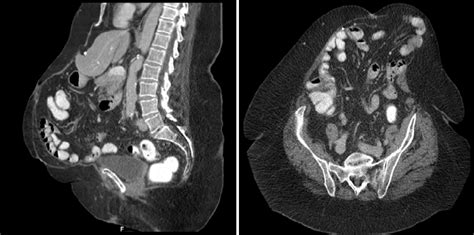Ct Scan Of A Patient With A Large Incisional Hernia The Hernia