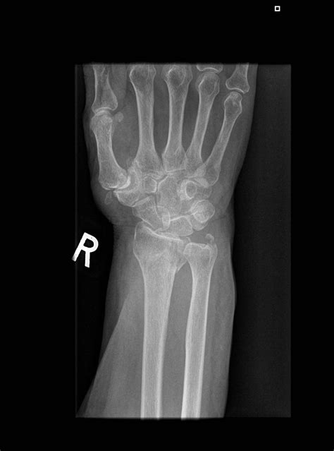 Distal Radial And Ulnar Styloid Fracture Image Radiopaedia Org