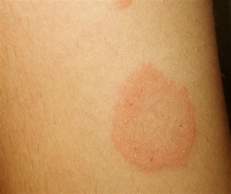 Pityriasis Rosea Pictures Treatment Causes Contagious Symptoms