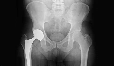 Imaging Guardrails Optimize Anterior Approach To Hip Replacement