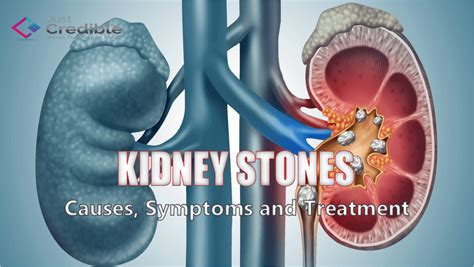 Kidney Stones Causes Symptoms And Treatment Options Just Credible