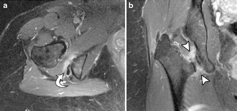 Impingement Of Lesser Trochanter On Ischium As A Potential Cause For