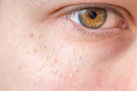 Eyelid Bumps 101 How To Identify Styes Milia And Pimples Allure