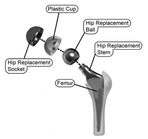 Mechanical Joint Implant Images Hip And Knee Handbook Of Joint