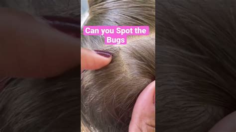 Can You Spot The Bugs 🐜 L Lice Removal Service Stacey The Louse Lady