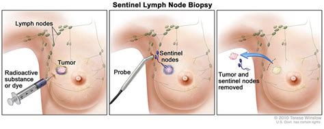 Lymph Node Removal In Early Stage Breast Cancer National