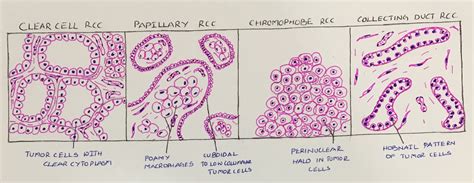 Renal Cell Carcinoma Histopathology Guru