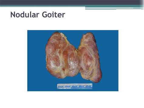 Ppt Goiter And Thyroid Cancer Powerpoint Presentation Free Download