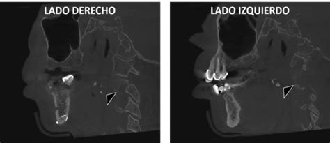 Tonsilolitos Dento Metric Radiología Dental Oral Y Maxilofacial
