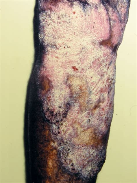 Figure Chromoblastomycosis DermNet New Zealand StatPearls NCBI