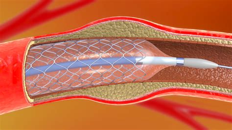 Catheters Medical Community Urged To ‘immediately Stop Using Affected