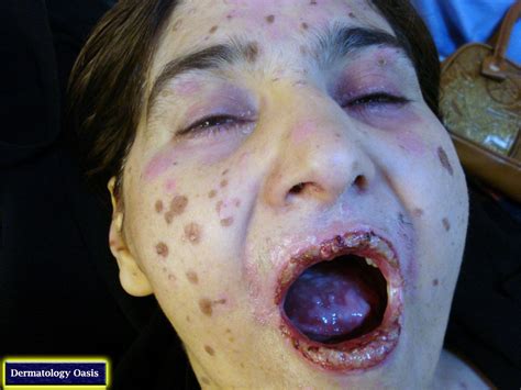 Although progress has been made in the management of sjs through. Stevens Johnson syndrome | Dermatology Oasis
