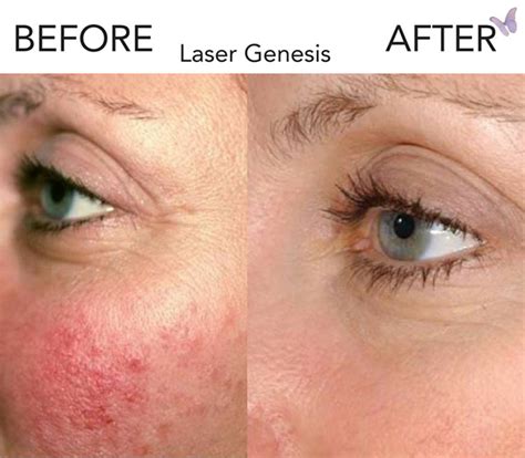 Laser Genesis At Home Healthyhappylady