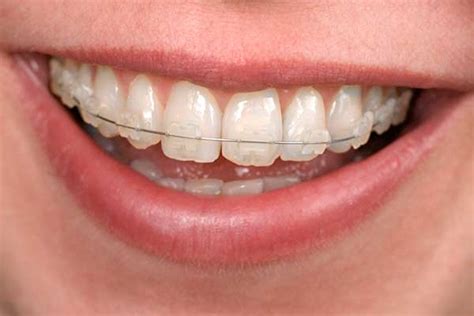 Newington Clear Braces Provider Greater Hartford Orthodontics
