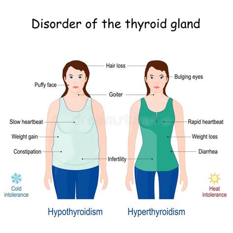 Comparison And Difference Between Hyperthyroidism And Hypothyroidism Stock Vector Illustration
