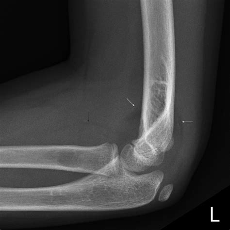 The Paediatric Elbow Wikiradiography