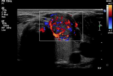 Colour Doppler Image Of Malignant Thyroid Nodule Show Increased And
