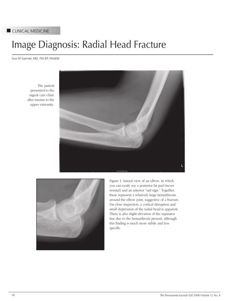 Pdf Image Diagnosis Radial Head Fracture
