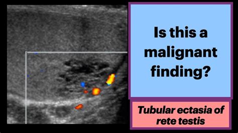 Tubular Ectasia Of The Rete Testis Radiology Urology Ultrasound