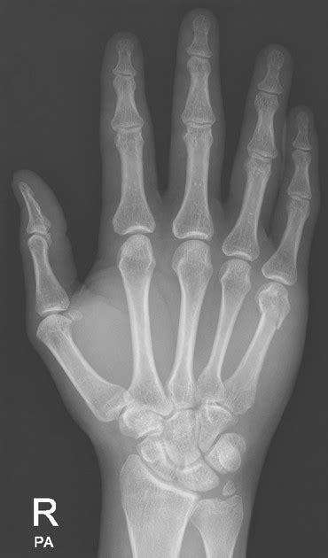 Persistent Ulnar Styloid Ossicle Pacs