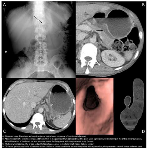 Gastric Ulcer What To Look For In Ct Imaging And Virtual Gastroscopy