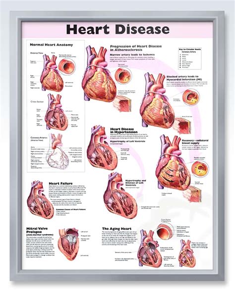 Heart Disease Exam Room Human Anatomy Poster Clinicalposters