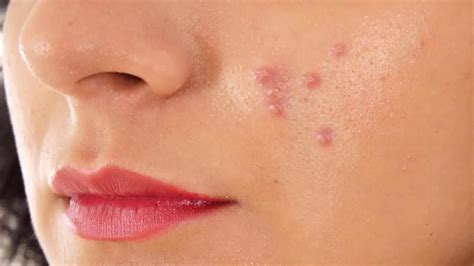 Oily Skin Pimples Remove At Home Oily Skin Se Pimple Hatane Ka Tarika