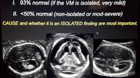 Fetal Ventriculomegaly Radiology Severe Mild