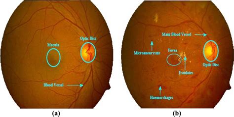 Digital Retinal Image A Normal Retinal Image B Diseased Retinal