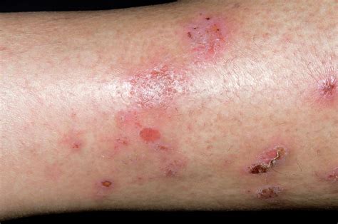 Spongiotic Dermatitis On The Leg Photograph By Dr P Marazziscience