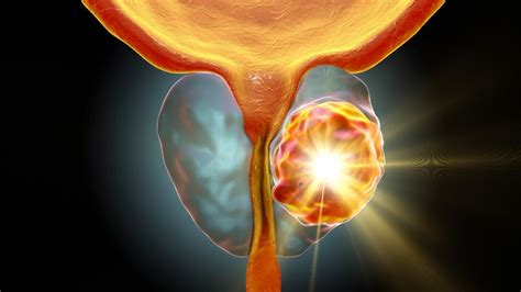 Hold Off Radiotherapy After Prostate Cancer Surgery