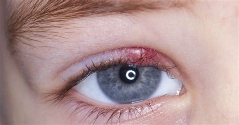 I like your eyes, jacque. If you wake up and your eye looks like this - try these 10 ...