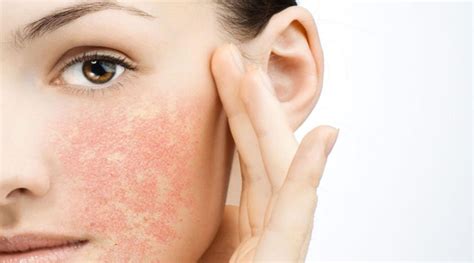 Understanding Persistent Skin Redness Causes And Management Fonexcode