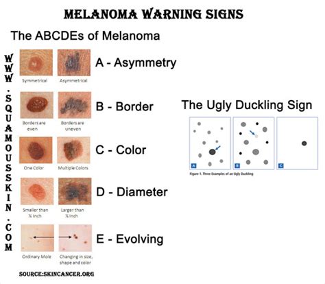 The Abcdes Of Spotting Melanoma