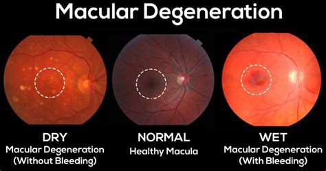 Macular Degeneration Endo Eye Doctors Of Hawaii Optometrists In