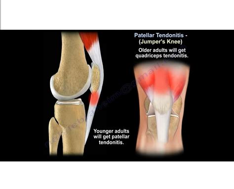 Patellar Tendinitis Jumpers Knee —