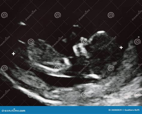Fetus Image Stock Image Image Of Unborn Sonogram Womb 30080839