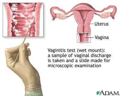 The Wet Mount Vaginitis Test Medlineplus Medical Encyclopedia Image