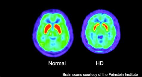 Huntingtons Disease Effect Of Neurodegenerative Diseases On Neurons