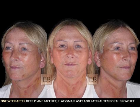 Stages Of Facelift Recovery Dr Dominic Bray