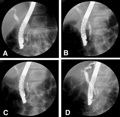Safety And Long Term Outcomes Of Endoscopic Papillary Balloon Dilation