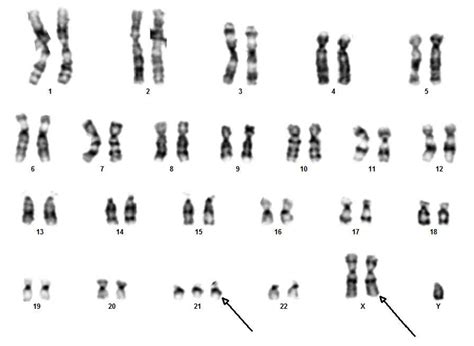 Chromosome Complement And Karyotype 48xxy21 Of The Fetus Download Scientific Diagram