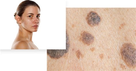 Irregular Brown Spots Advanced Dermatology